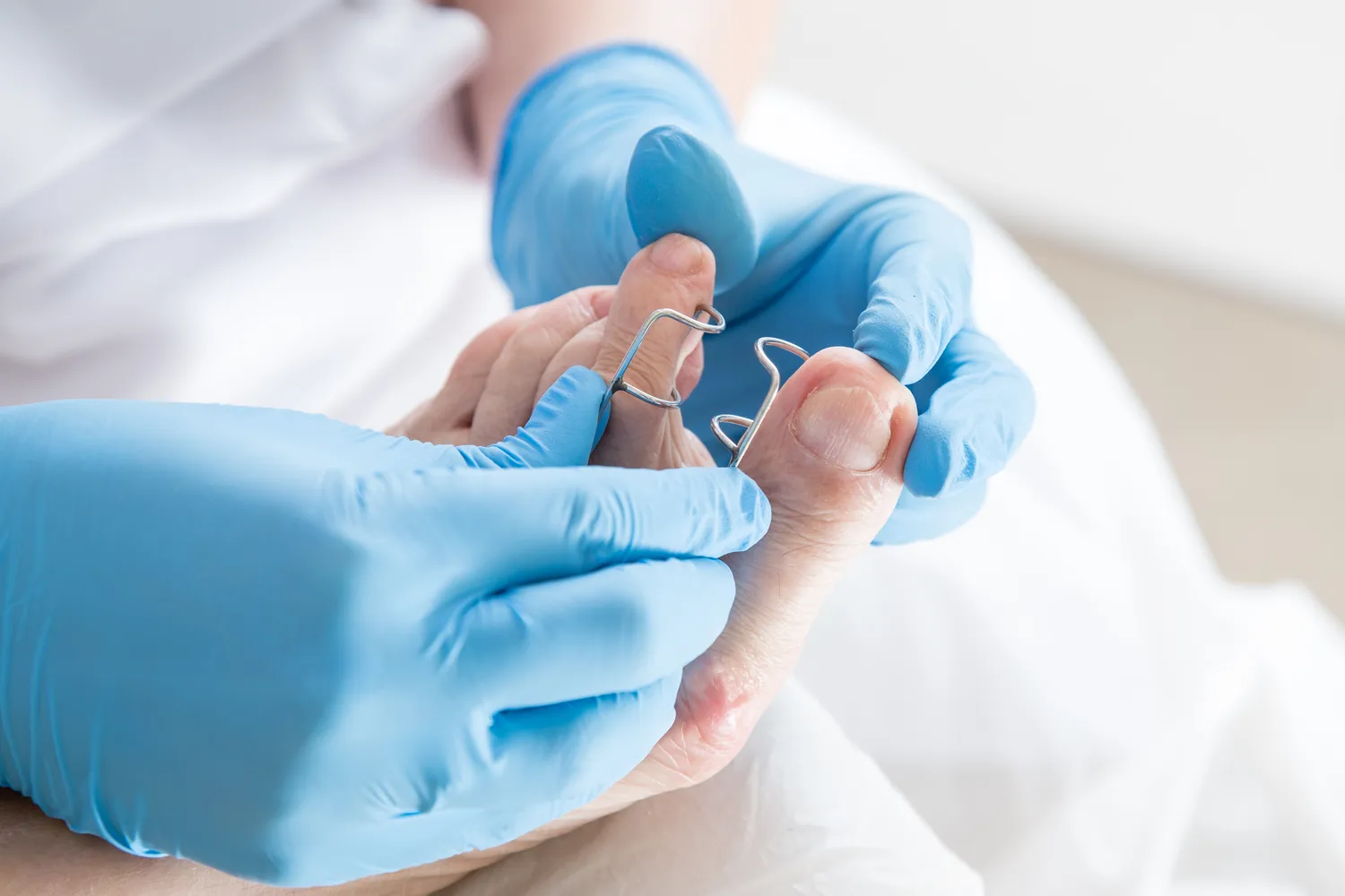 jakich-cazkow-uzywac-do-usuwania-skorek-u-stop-1